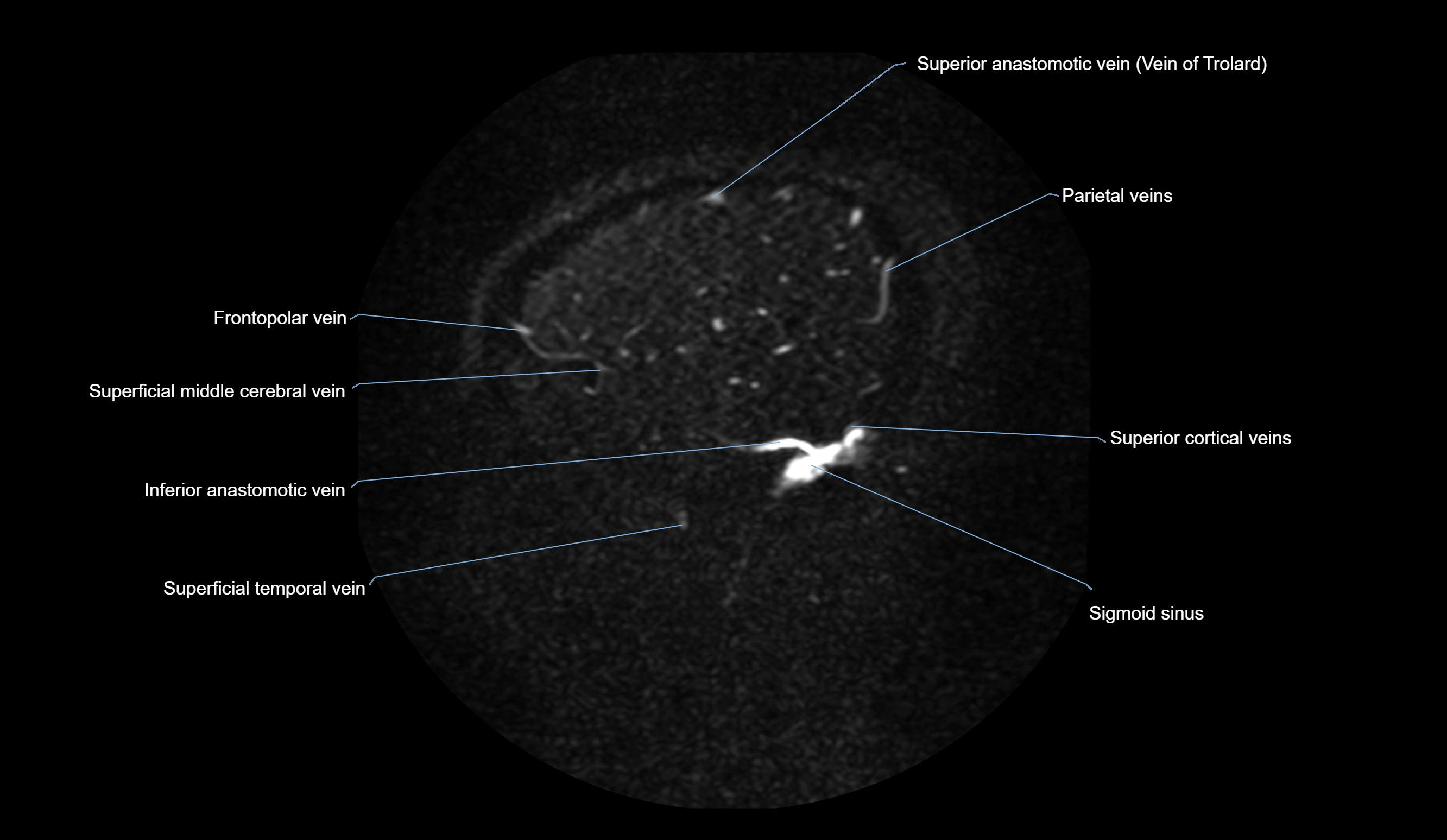 MRV brain sagittal anatomy 3T MRI images -img-01015-00069.webp